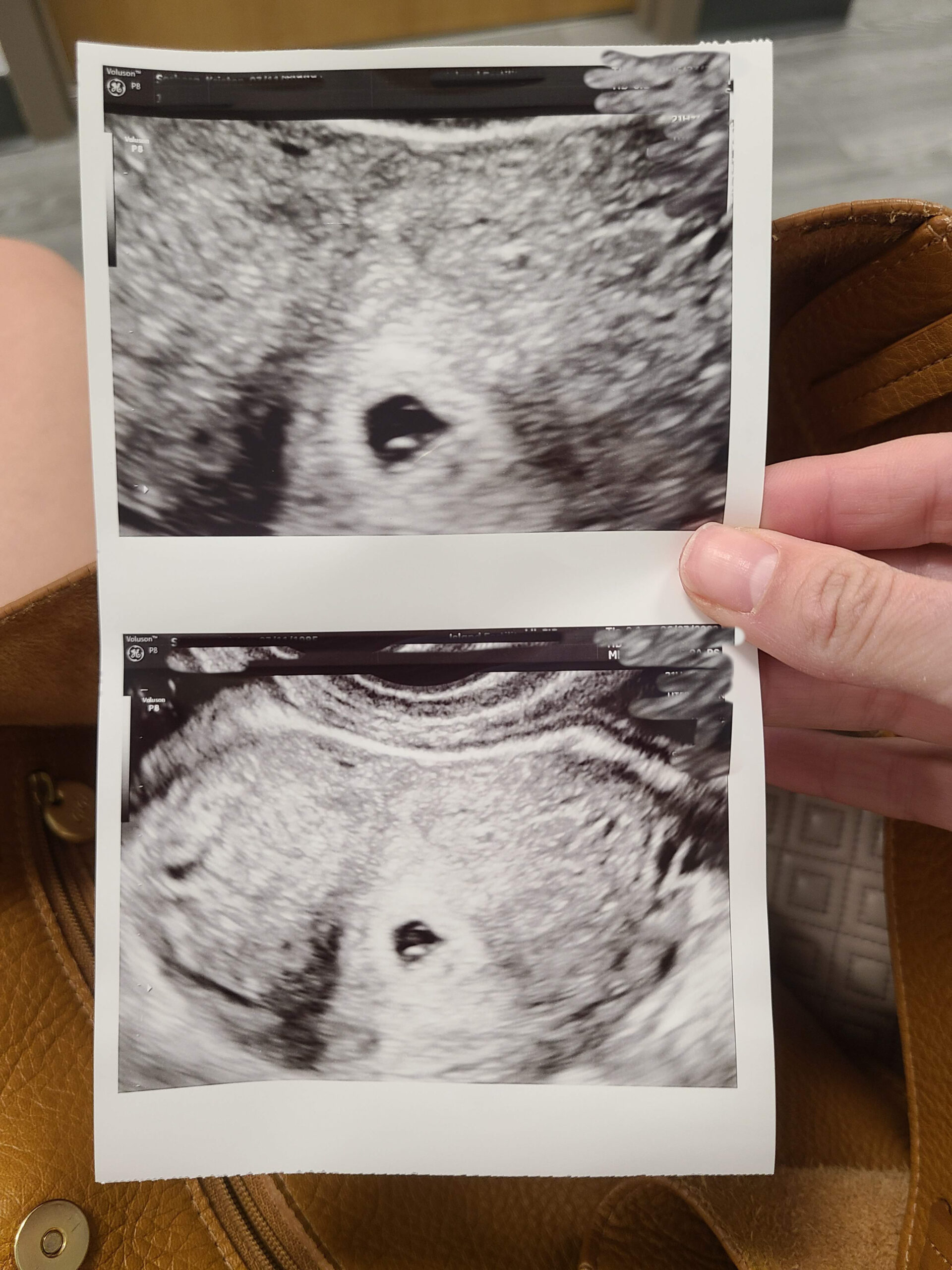 5 Week Ultrasound Photo
