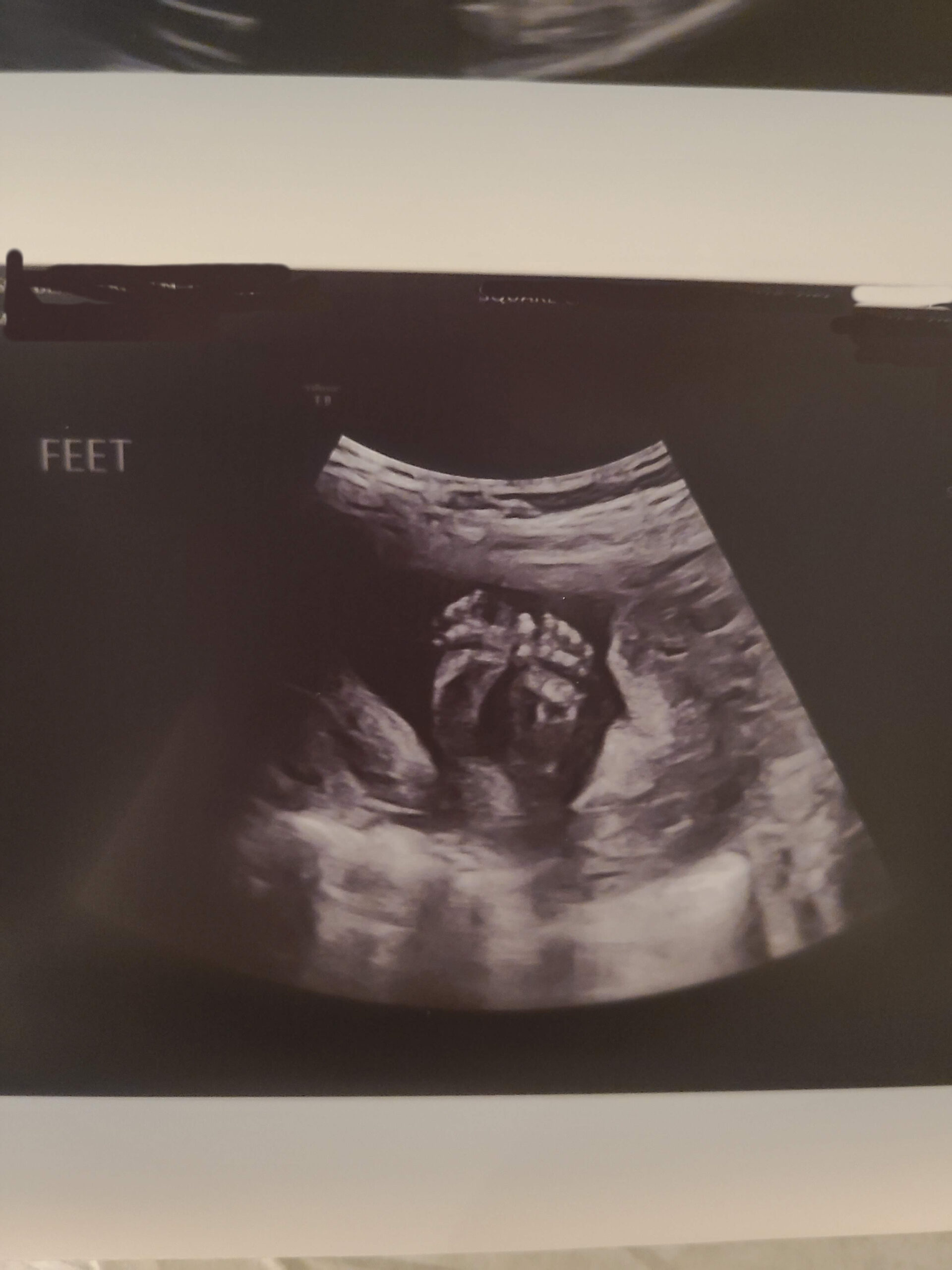 20 week Ultrasound Photo
